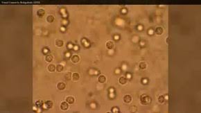 Urinary Tract Infection Wikipedia