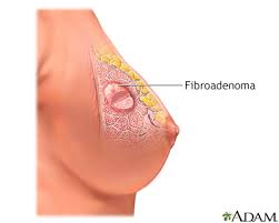 Felt in the breast or groin region. Breast Lump Information Mount Sinai New York
