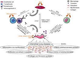 Interstitial Lung Disease In Systemic Sclerosis Sciencedirect