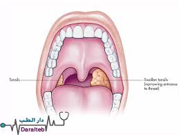 يذكر ان التهاب اللوزتين يحصل عادة عند إصابتهما بعدوى بكيتيرية أو بفيروس معين، وأحد أبرز أعراض التهاب اللوزتين هو وجود التهاب واحتقان في الحلق والأعراض الأخرى الشائعة قد. Ø§Ù„ØªÙ‡Ø§Ø¨ Ø§Ù„Ù„ÙˆØ²ØªÙŠÙ† Ø¹Ù„Ø§Ø¬ Ø§Ù„ØªÙ‡Ø§Ø¨ Ø§Ù„Ù„ÙˆØ²ØªÙŠÙ† Ø¹Ù„Ø§Ø¬ Ø§Ù„Ù„ÙˆØ² Ù…ÙˆØ³ÙˆØ¹Ø© Ø¯Ø§Ø± Ø§Ù„Ø·Ø¨
