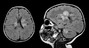 Frederik barkhof and robin smithuis. Multiple Sclerosis In The Very Young Consult Qd