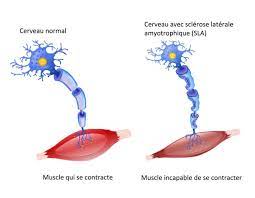 Les premiers symptômes d'une sla sont souvent des crampes et des secousses musculaires (fasciculations), ou parfois des difficultés à avaler ou . Maladie De Charcot Age Premiers Symptomes Esperance De Vie