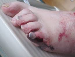 Fair skinned older people are more likely to develop the condition. Retiform Purpura Dermnet Nz