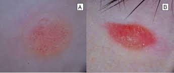 Image result for Spitz Nevus