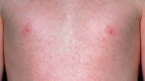 When a rash appears on any part of the body, the skin become red, swollen and blotchy. Common Skin Rashes Everyday Health