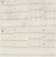 Myocarditis (mk) is a cardiovascular disease characterized by heart muscle damage due to the development of inflammation in the tissues of the the most frequent ecg signs of myocarditis Acute Myocarditis Mimicking Myocardial Infarction Can Misdirect The Diagnostic Approach Sciencedirect