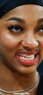 WNBA player's lip zit sparks controversy and reactions