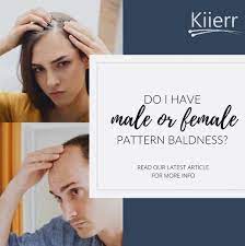Do I Have Male Or Female Pattern Baldness Kiierr In 2020 Pattern Baldness Female Pattern Baldness Balding