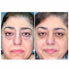 Image result for Proptosis