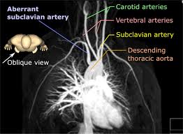 Ok.so on the windows sticker it reads: Aberrant Subclavian Artery Wikipedia