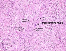 Schwannomas of other cranial nerves, meningiomas, ependymomas, and gliomas schwannomatosis presents with multiple schwannomas involving skin or soft tissue Cureus Rare Case Of A Transverse Colon Schwannoma