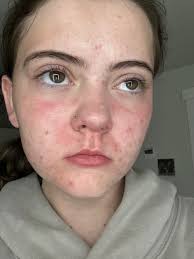 When your going through a Flair Up, does anyone have Angry feelings?  Because mine lasted for 2-3 days. And I wasn't sure why I was angry? The  only thing I feel that