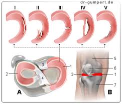 Ärzte sollten bei degenerativen meniskusrissen nicht gleich eine arthroskopische operation einleiten. Meniskusriss