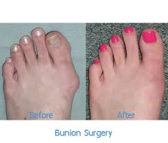 In recent years, lasers have shed their science fictional image to become a surgeon's and dermatologist's most promising weapon in the fight against aging skin. Non Visible Scar Bunion Surgery Arches Foot Institute Surprise Az Podiatrist Surprise Az Foot Doctor