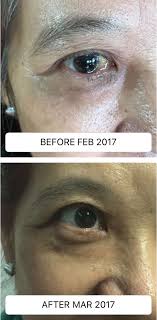 Before And After Photo Of A Lady With Pinguecula A Jelly Like Yellowish Slightly Raised Thickening Of The Conjunctiva On The Whi Parts Of The Eye Eyes Photo