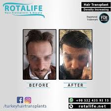 Hair Transplant In Turkey