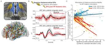 Image result for Thalamic Stimulation