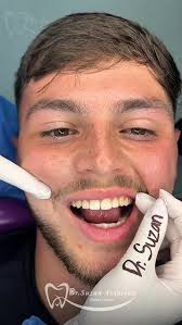 Just comment 1 to send you information🥰🥰🥰 This is Dr Suzan. I have more  than 10 years experience in dental and aesthetic field. Non shaving veneers  by dr Suzan My main page👇👇 @