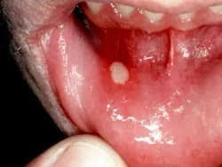 Image result for Canker sores symptoms roof of the mouth