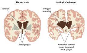 Huntington S Disease A Rare Genetic Disorder Of The Brain Medanta