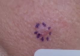 Get detailed information about the diagnosis and treatment of newly diagnosed and recurrent merkel cell carcinoma in this summary for clinicians. A Close Look At Common Lid Lesions