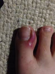 Keep toenails at a moderate length.trim toenails so they're even with the tips of your toes. Infected Toe Ridiculous I Know But Anything I Can Do Mumsnet