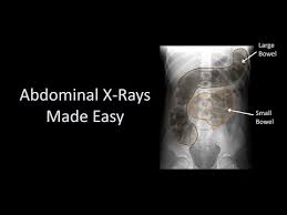 Image result for Abdominal XRay