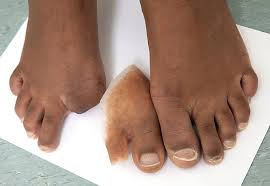 Image result for toe amputation