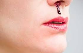 Apa punca hidung berdarah hingga buat tak selesa? Doktor Ini Kongsi 10 Sebab Mengapa Hidung Berdarah Dengan Kerap Walaupun Fizikal Kelihatan Sihat