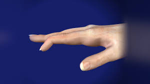 A mallet finger results when the extensor tendon is cut or torn from the attachment on the bone. Mallet Finger Orthovirginia