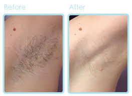 Laser hair removal post procedure instructions after laser hair removal, you may experience a slight sunburned or razor burned feeling on the treated areas. Laser Hair Removal L Spa Sarasota