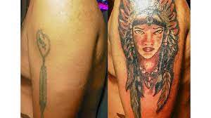 It must be medically necessary. Tattoo Removal How To Costs Before And After Pictures More