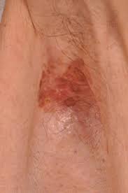 Extramammary Paget Disease Immunohistochemistry Is Critical To Distinguish Potential Mimickers