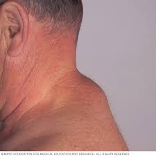 الورم الشحمي الأعراض والأسباب mayo clinic مايو كلينك