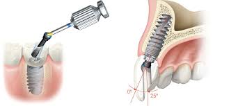 How Long Does It Take To Replace My Teeth Dental Implants Need To Integrate Into The Bone Tis