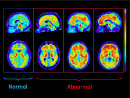 An animation i made describing the differences between these three scans'. Plaques In Brain Scans Forecast Cognitive Impairment Imaging Technology News
