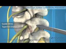 Atlantic Spine Center Offers Expertise In Endoscopic Spine Surgery A Minimally Invasive Surgery Providing Smaller Incisions Le Spine Surgery Lumbar Procedure