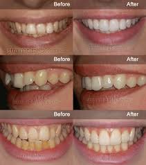 The inman aligner is one of the most common options in the uk for adults wanting to straighten their teeth without fixed braces, but is it right for you? Inman Aligner Bury St Edmunds Fast Teeth Straightening