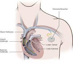 Wann benötigt man einen herzschrittmacher? Wie Funktioniert Ein Herzschrittmacher