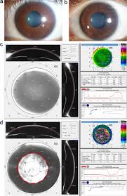 Cloudy Cornea Treatment | Corneal Opacity Treatment | Iranian Surgery