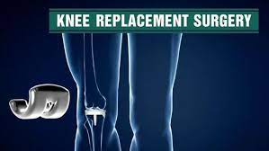 Knee Replacement Surgery In India Knee Replacement Surgery Knee Replacement Knee Implants