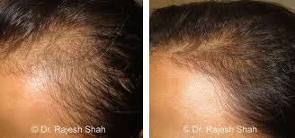 Caster oil is an essential oil that has been used as a remedy for hair loss for a long time. Homeopathic Medicines And Treatment Highly Effective No Side Effects At Life Force Homeopathy Clinic