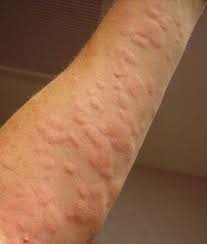 How Can You Get Hives Natural Remedies Natural Cough Remedies Natural Remedies For Hives Hives Remedies