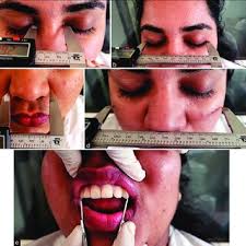 PDF) An anthropometric assessment method for facial profile determination  in forensics