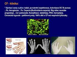 Mukoviscidóza) je autozomálně recesivní duktivní kašel, pískoty, hyperinflace, paličkovité. Ppt Cysticka Fibroza Mukoviscidoza Powerpoint Presentation Free Download Id 4731515