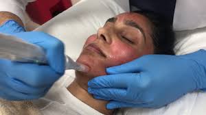 It features more speed, accuracy, power. Microneedling Treats Fine Lines Enlarged Pores And Uneven Skin Texture Youtube