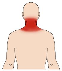Both the deltoid and the trapezius are firmly attached to the spine of the scapula. Neck Sprain Orthoinfo Aaos