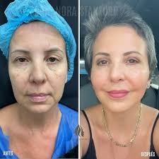 𝐃𝐑 𝐍𝐎𝐑𝐀 𝐒𝐓𝐀𝐍𝐅𝐎𝐑𝐃 𝐏𝐥𝐚𝐬𝐭𝐢𝐜 S𝐮𝐫𝐠𝐞𝐨𝐧