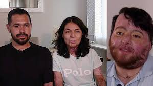 "El dolor te cambia": tras sufrir quemaduras en incendio, víctimas logran  seguir adelante