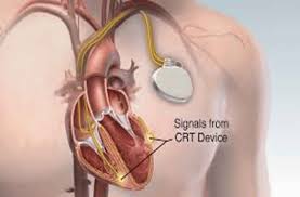 Image result for Internal Cardiac Defibrillator